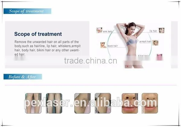 Laser Type and Stationary Style Diode Hair removal laser