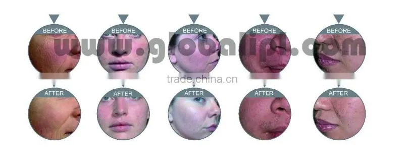 multifunction oxy peel made in China