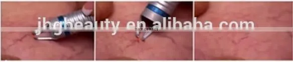 Good price blood vessels removal 980nm diode laser spider vein removal machine