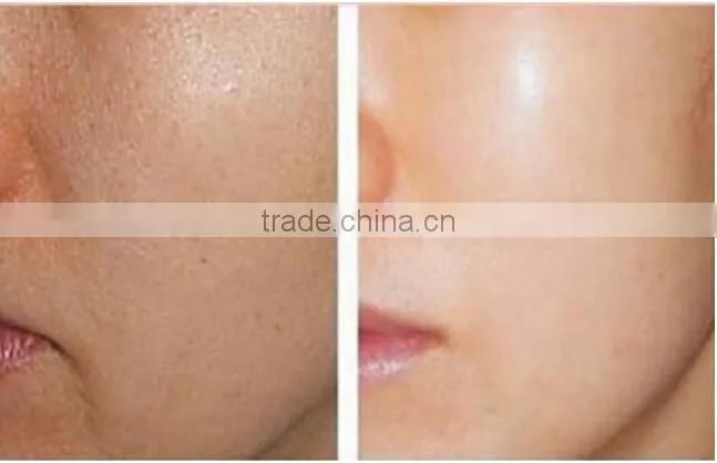 2017 Newest meso injection gun korea for hyaluronic acid gel injection / mesotherapy gun with CE Certificate