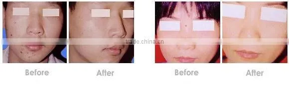rf co2 fractional laser