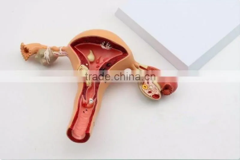 Human uterus and ovary vaginal pathological changes model of reproductive Department of gynecology medical demonstration model