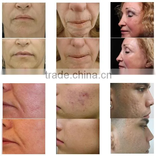 Fractional rf microneedle stretch marks removal with auto-adjust head