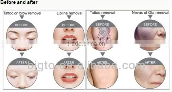 new shape new feeling GTO brand portable one Q switched Nd yag lasrs for tattoo removal and pigments removal