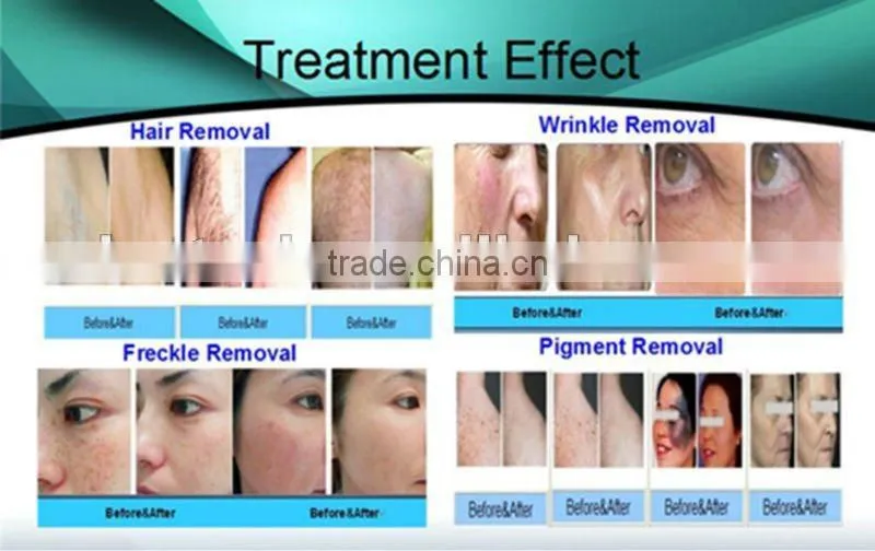 Best selling 3s beauty e-light bio rf