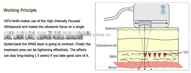 New product 2015 high intensity focused ultrasound HIFU OD-H6