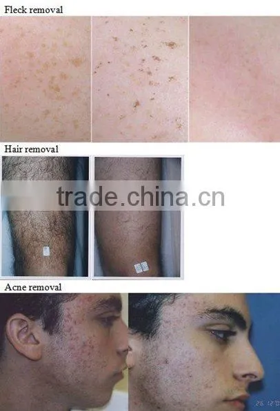 Monopolar handle Elight IPL RF hair removal beauty equipment