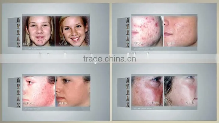 Multifunction facial cleaning brush microdermabrasion skin jet peel machine