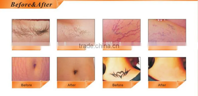 Professional OPT spot removal/RF skin rejuvenation/medical ND-yag tattoo removal