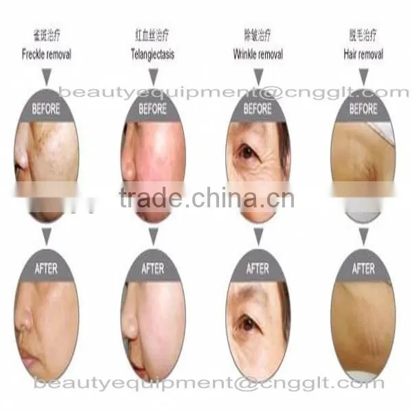IPL+RF Hair Removal natural hair removal soap