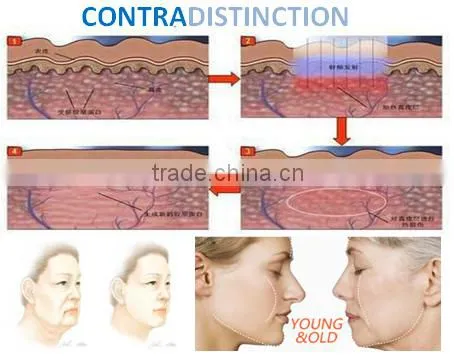 Best no needle cooling RF skin beauty machine for home use