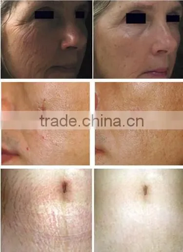Noninvasive fractional micro needle rf equipment