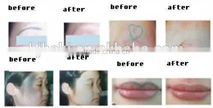 2015 new pianess safe tattoo removal & vascular treatment