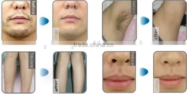 Diode Hair Removal Laser As Lumenis Lightsheer Duet And Alma Soprano XL