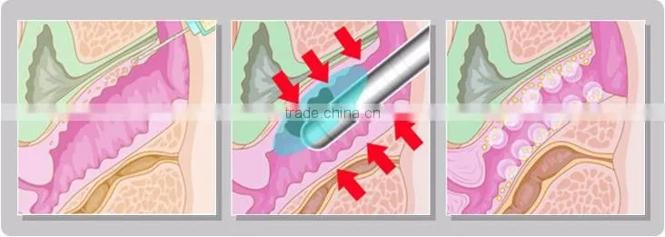 New arrival private rejuvenation vaginal tightening hifu system with 2 transducer