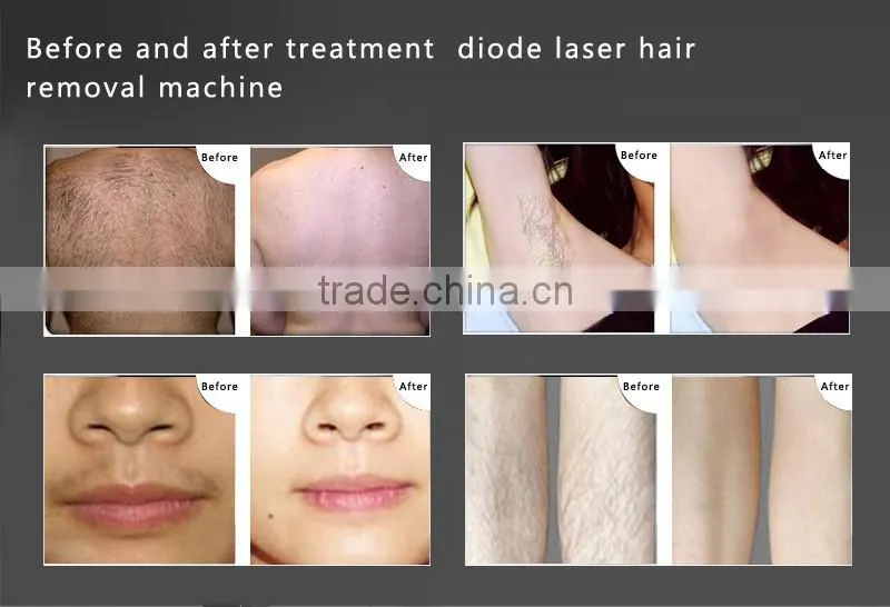 Lingmei 808nm diode laser permanent hair removal system