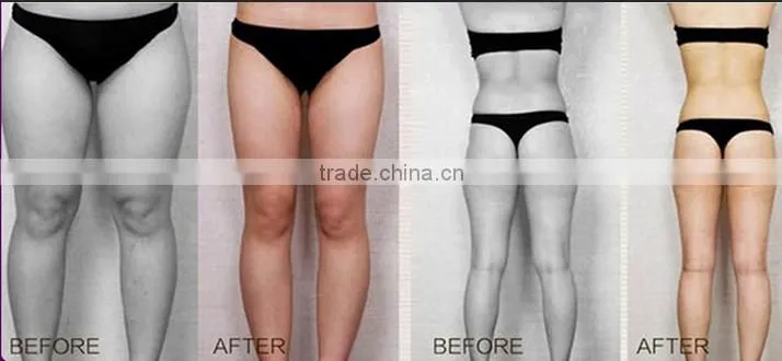 Micro machine liposonix hifu fat reduction 2016 new lipo slimming machine in alibaba