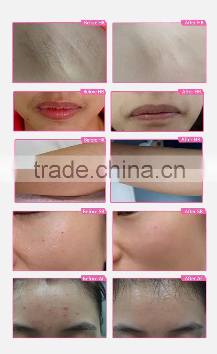 CE, PSE, ROHS approved DEESS 3functions in 1 ipl skin rejuvenation machine home with ipl xenon lamp