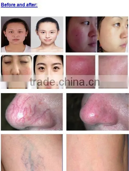 Hotsale Vein Stopper/ Vein Wave Machine/ Spider Vein Removal