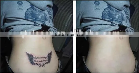 best nd yag q switched embroidery machines for tattoo removal tatoos permanent machine