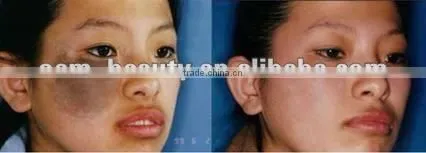 2012 Cheap portable laser machine for pigment blackhead removal