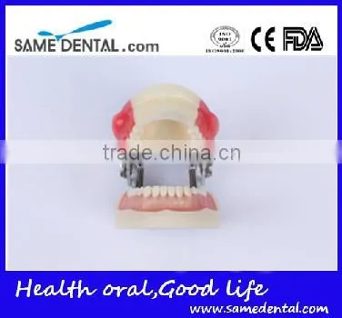 Abscess and tooth preparation model school teaching demonstration