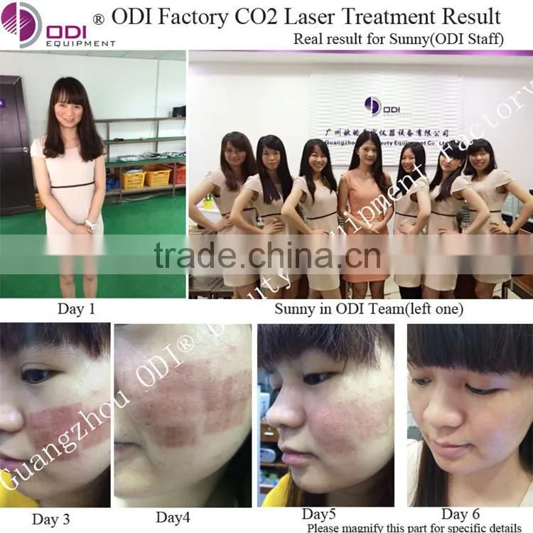 Innovative product medical carbon dioxide co 2 fractional laser skin laser resurfacing