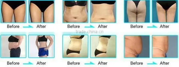 lipo freeze treatment coolsculption areas/ non surgical belly fat removal