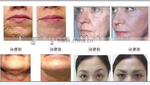 pimples and face black spot remover tm-097