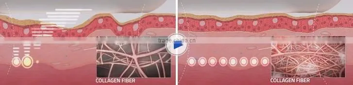 Vaginal HIFU Machine/Skin Tightening Machine/ Portable HIFU Machine
