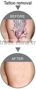New product in 2015 q switch nd yag laser tattoo removal system q-switched nd yag laser nd yag laser in china