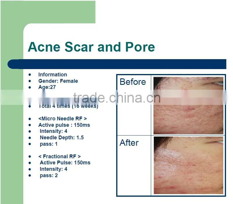 2016 best Micro Needle RF and Fractional RF system/ at home skin tightening machine