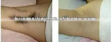 808nm diode laser machine medical intrument