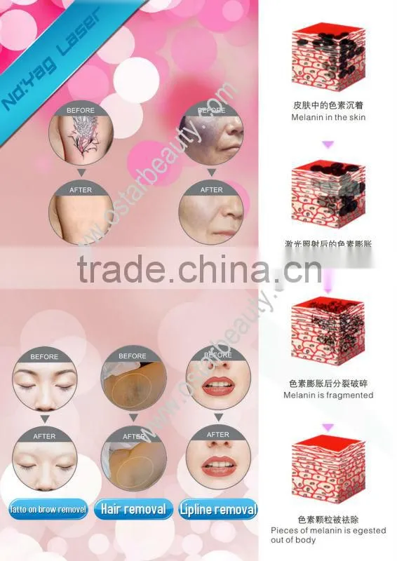 1064 532nm ipl yag laser hair removal and tattoo removal machine OB-NE 02