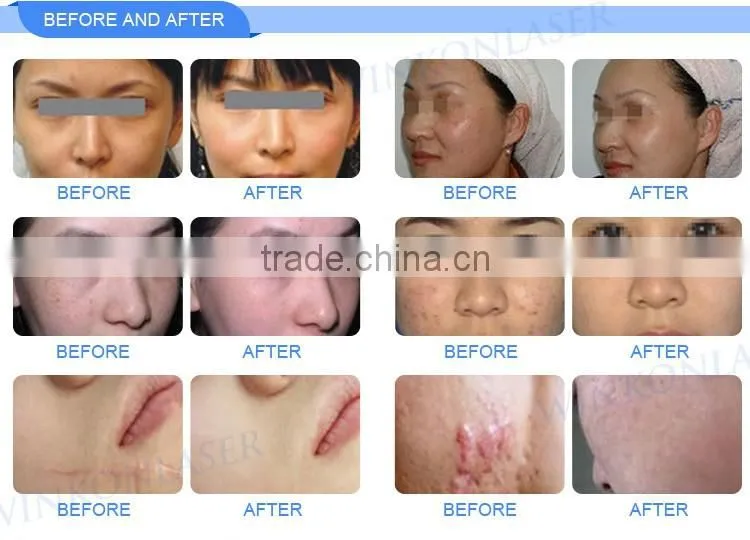 CE FDA certification RF fractional laser physiotherapy beauty equipment co2 laser machine