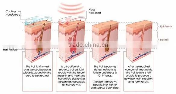 2016 professional Dialysis diode 808nm laser hair removal Machine for Sale