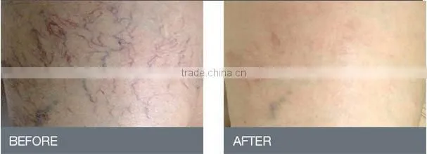 high frequency spider vein/vascular/blood vessels removal machine