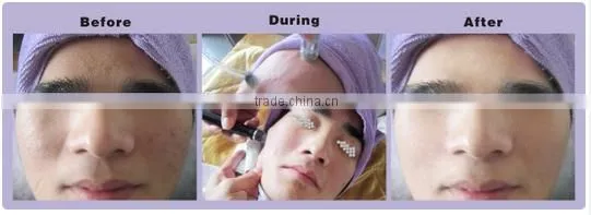 2015 Hot!!! hydra diamond dermabrasion facial skin cleansing machine