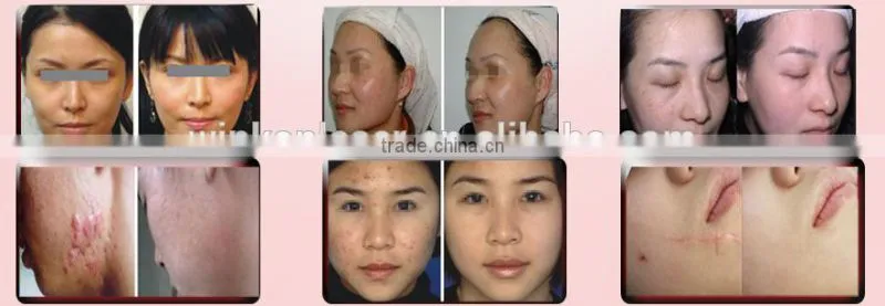 skin whitening laser / skin whitening machine