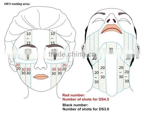 3D HIFU(High Intensity Focused Ultrasound)