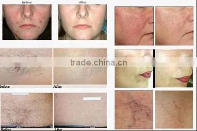 GI-13 portable one crystal hand IPL hair removal and skin care with best price