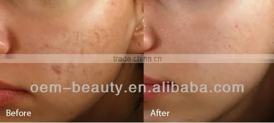 Best IPL handpiece portable ipl machine hair removal