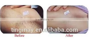 IPL intense pulsed light hair removal system