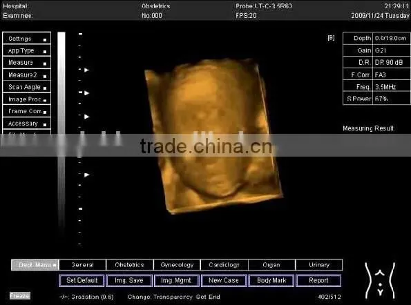 laptop ultrasound scanner with 3D function