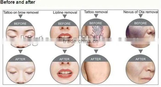 very professional 1064nm Q switched nd yag laser tatoo removal machine