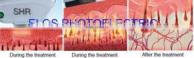 home shr ipl home laser hair removal