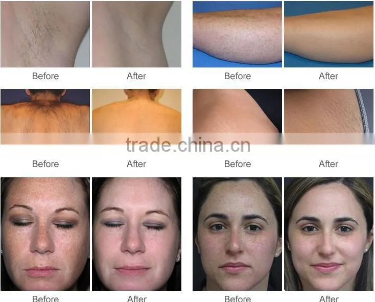 Aispirit combination machine YAG laser removal pigment and SHR handle for fast hair removal