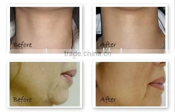 New design Skin lifting Derma roller 540 micro needle roller system with derma roller mts
