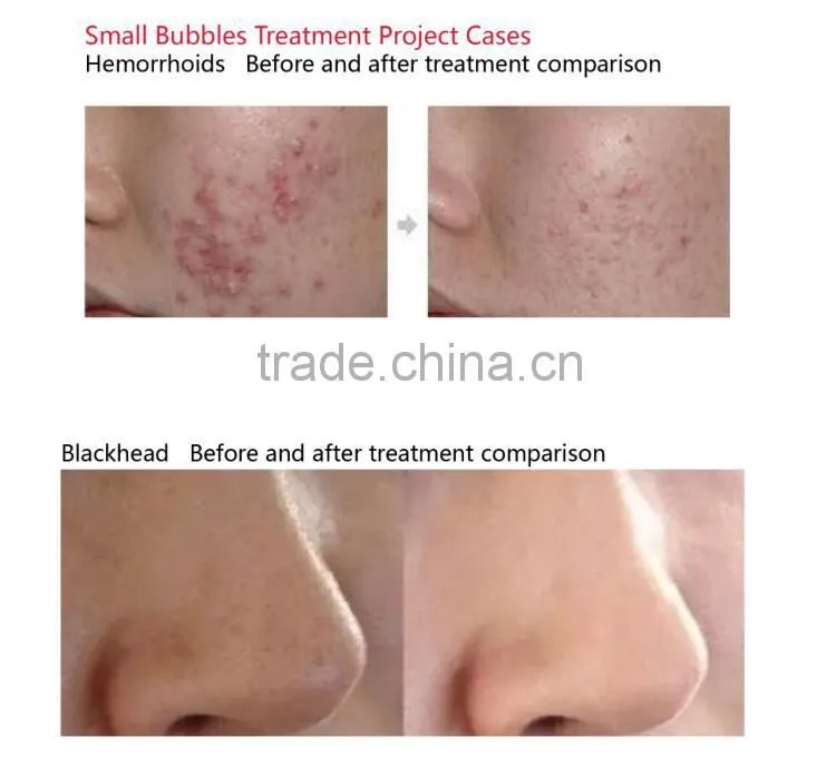 High Quality Shaping Firming Skin For Beauty Salon With CE Approved