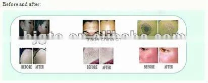 popular multi-functional beauty instrument(IPL+RF+nd yag laser)for hair removal,skin rejuvenation,laser tattoo removal